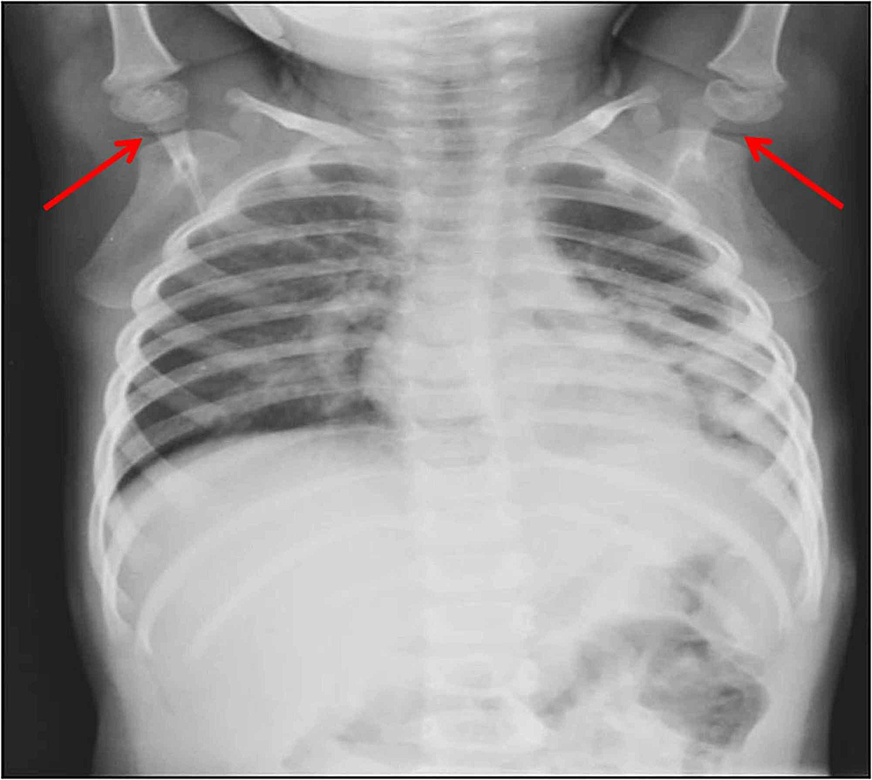 The Air Inside Joint A Sign of Disease Pathology or a Benign Condition