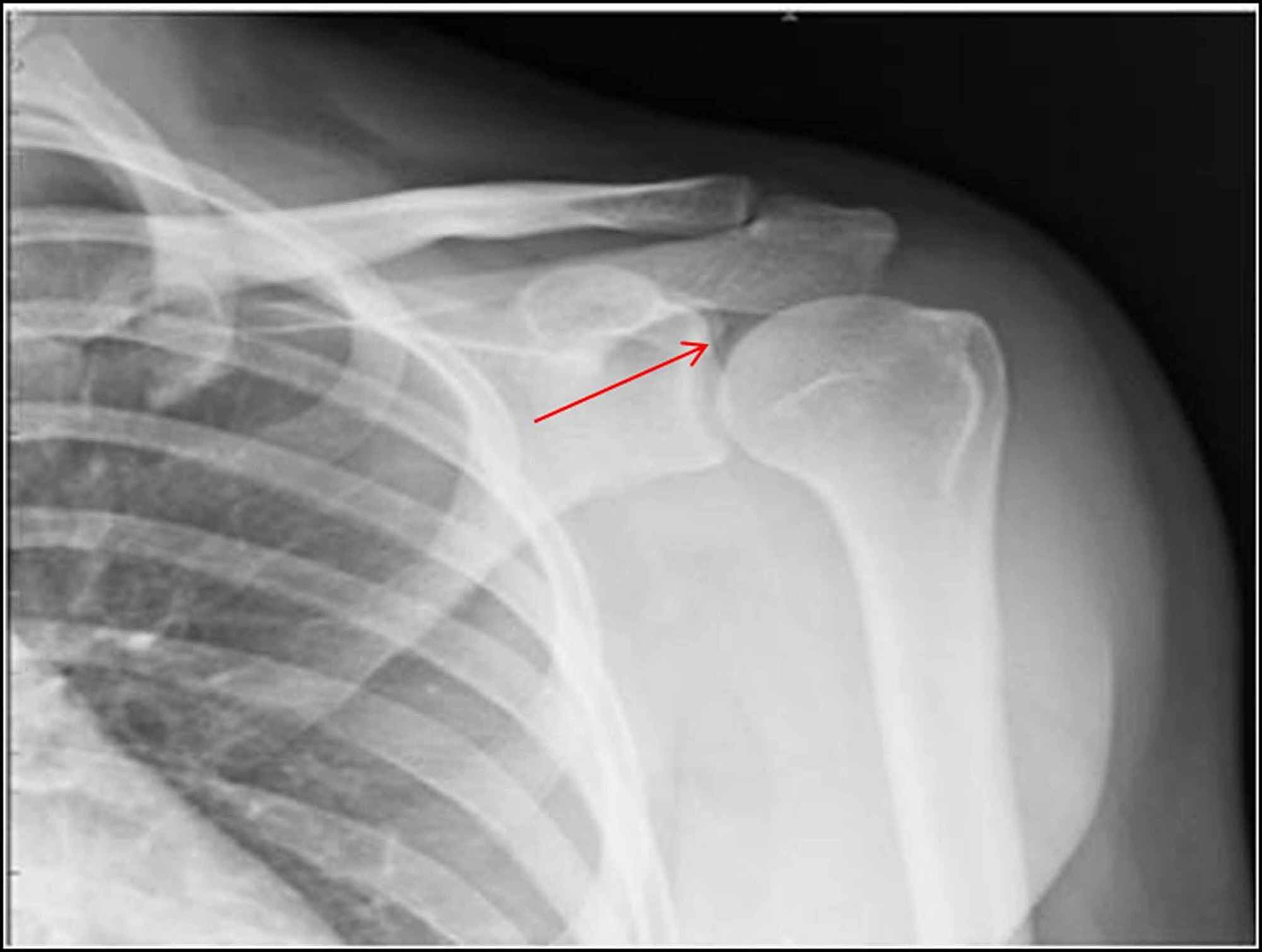 Cureus The Air Inside Joint A Sign of Disease Pathology or a Benign