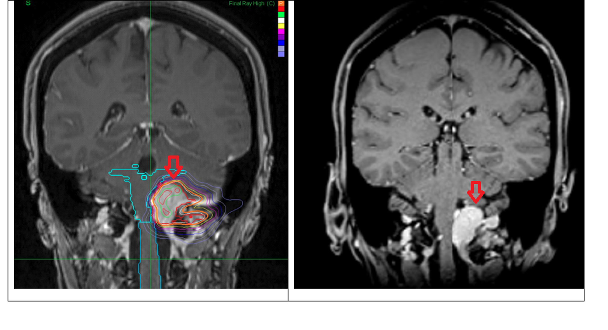 Cureus Unresectable Foramen Magnum Meningioma Treated With Cyberknife Robotic Stereotactic 7932