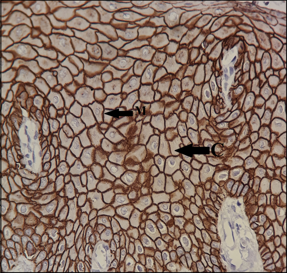 Comparison of E-Cadherin Expression in Oral Verrucous