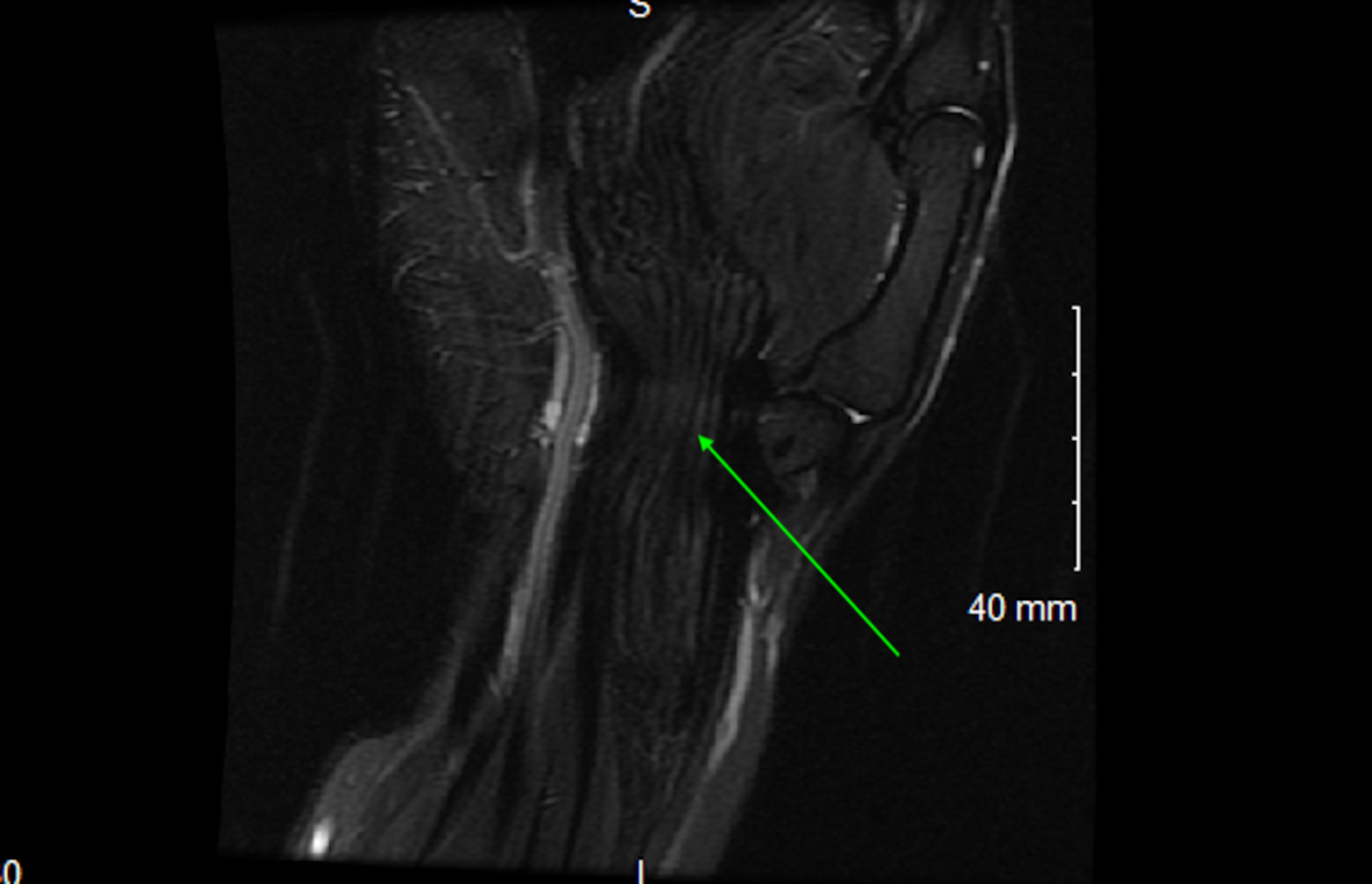 Cureus | Carpal Tunnel Syndrome Secondary To Fibrolipomatous Hamartoma ...