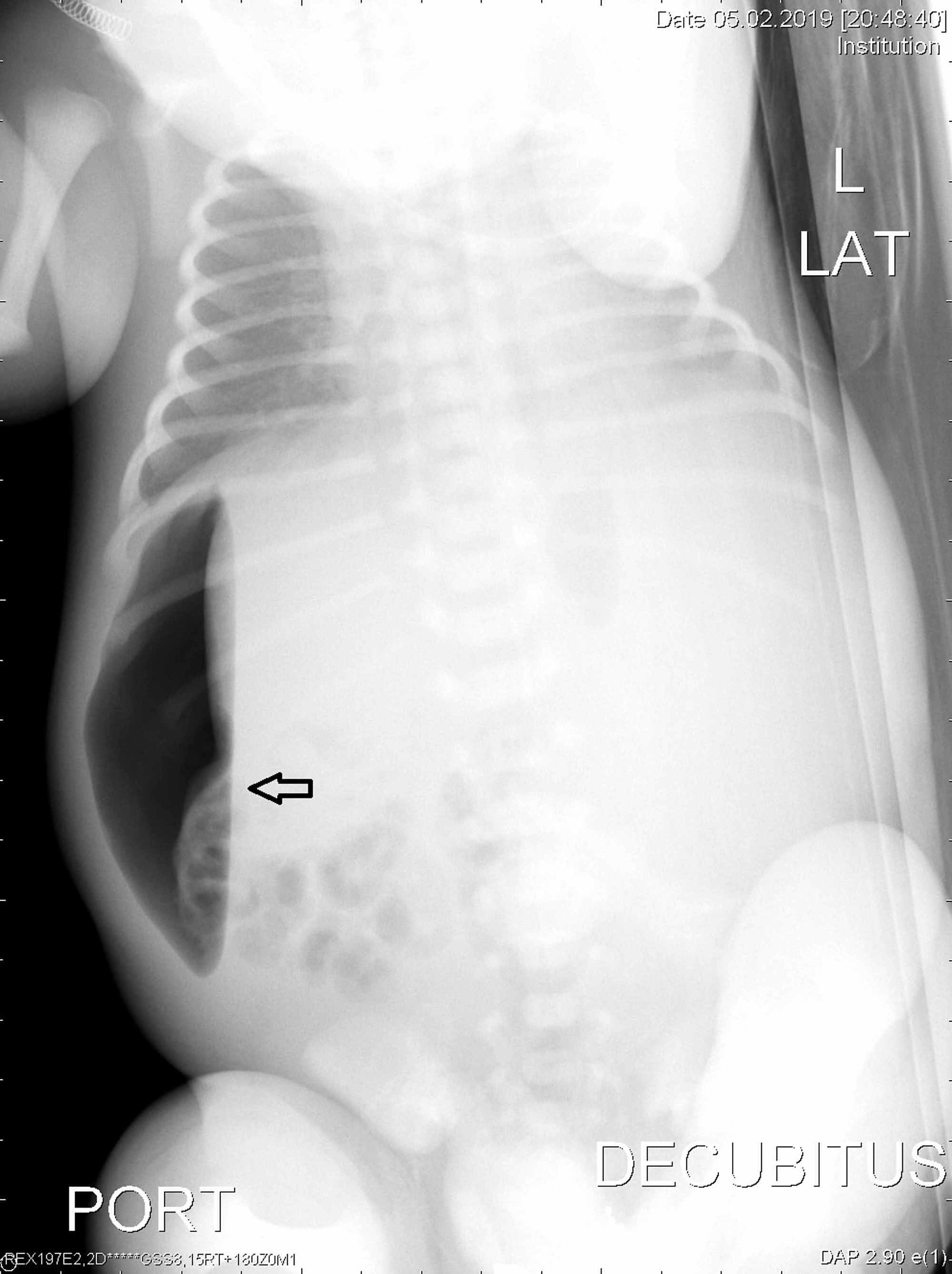 Cureus | Isolated Fetal Ascites: A Rare Cause