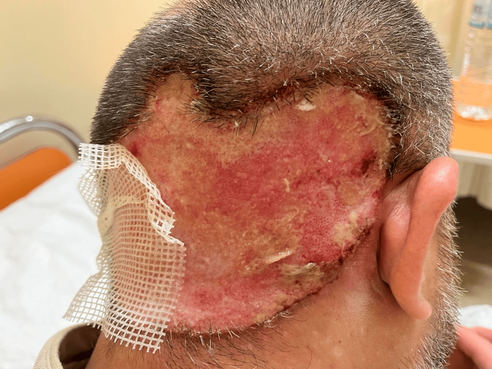 glutathione trichotillomania Trichotillomania in a Male Patient With Depression: A Case Report main image 0