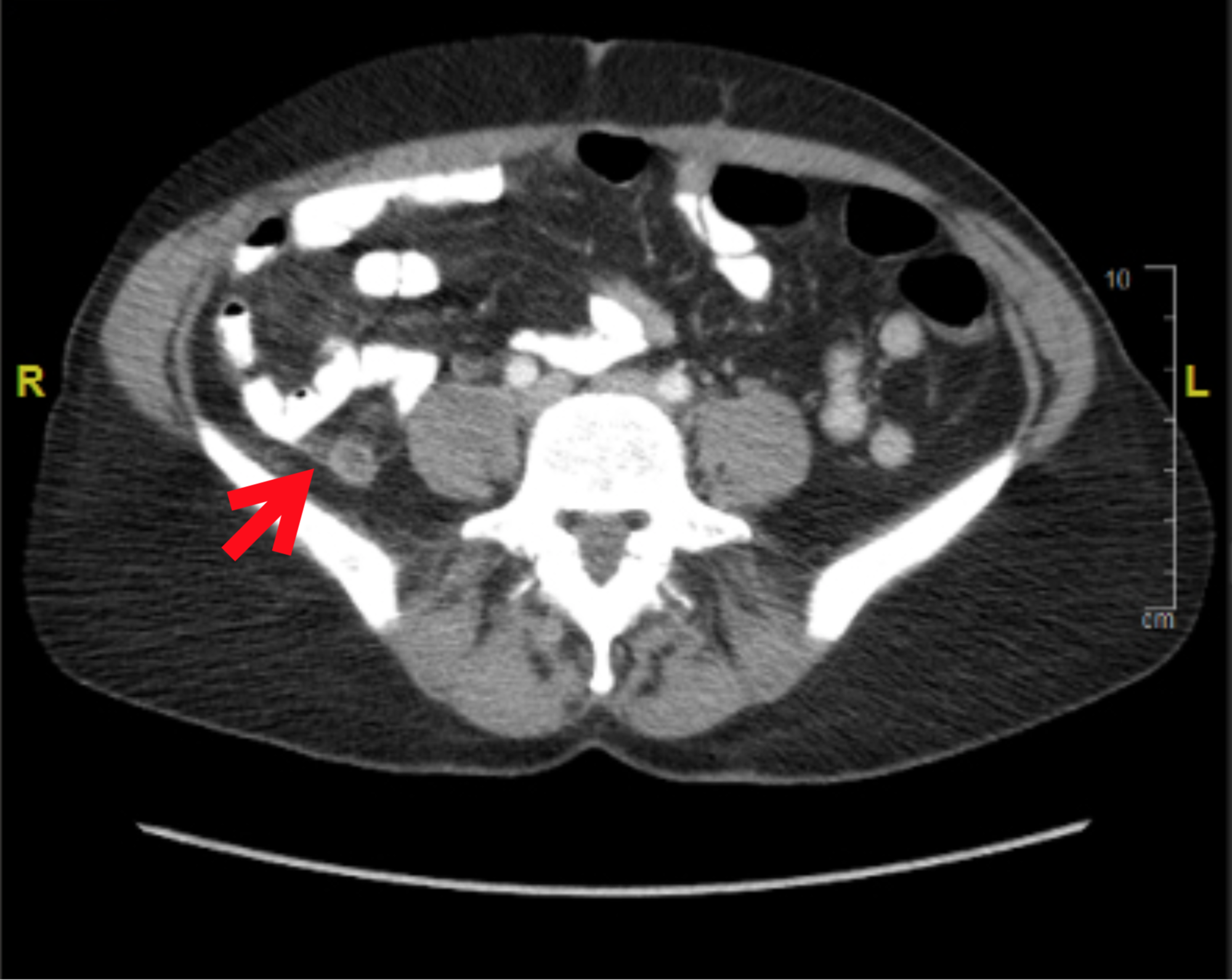 Appendicitis On Ct Scan 5167