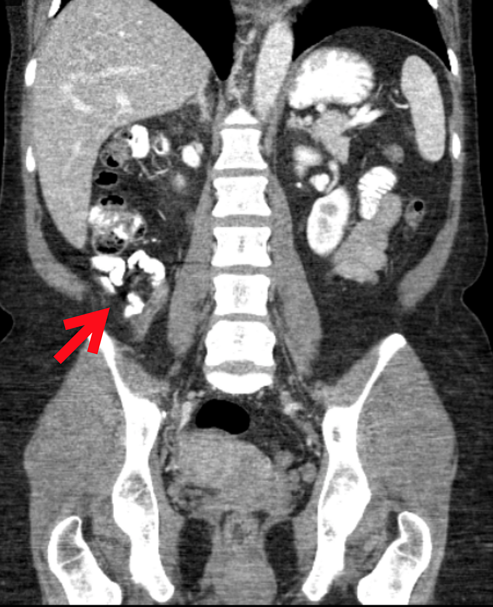 Appendicitis On Ct Scan   Article River 733a871094ad11ea8f265741e139fb5f Screen Shot 2020 05 12 At 7.55.59 PM 