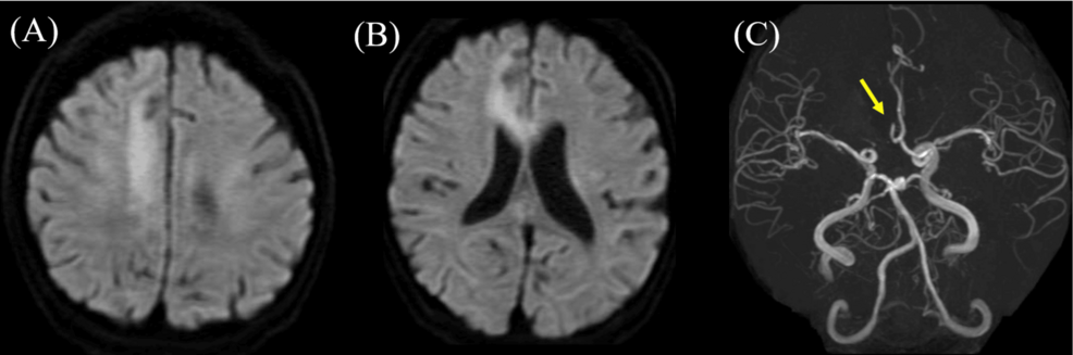 The-result-of-brain-MRI-and-MRA.