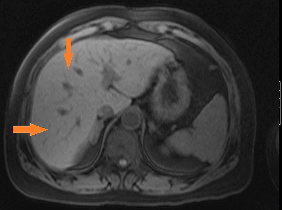 What Is Diffuse Hepatic Steatosis