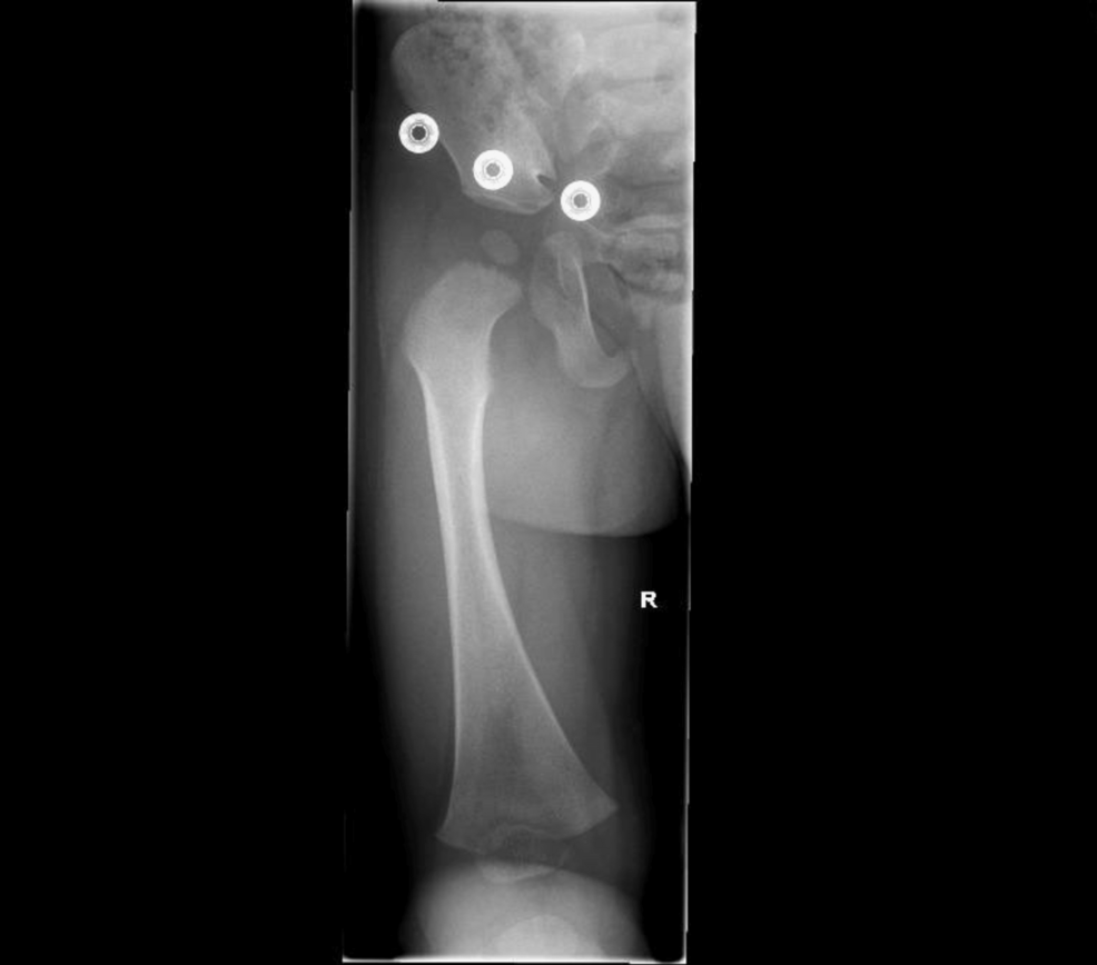 discitis-mimicking-septic-arthritis-in-a-17-month-old-boy-cureus