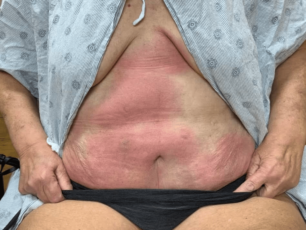 Coalescing-erythematous-plaques-with-ill-defined-borders-diffusely-spread-over-the-patient’s-abdomen