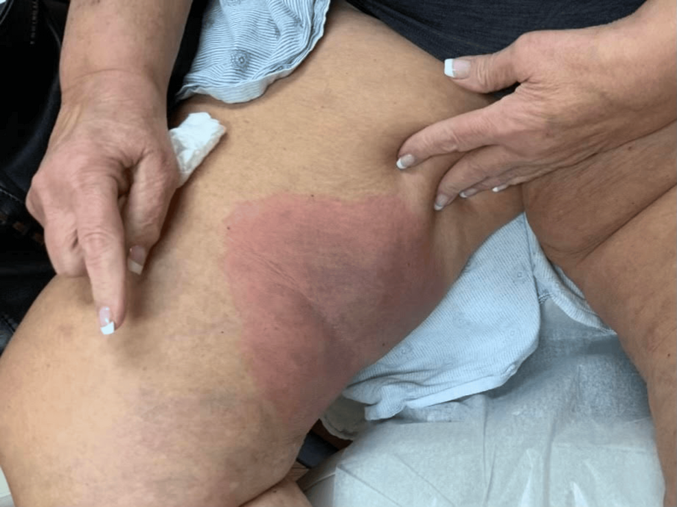 Site-of-the-patient’s-initial-rash-located-on-the-right-inner-thigh,-notable-for-its-increased-demarcation-and-central-violaceous-hue