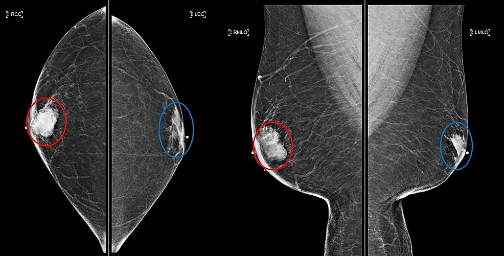 Subsequent-diagnostic-mammogram-sixteen-months-later-for-enlarging-right-breast-lump