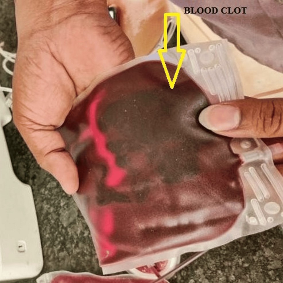 Clot in the Blood Bag: A Case Report