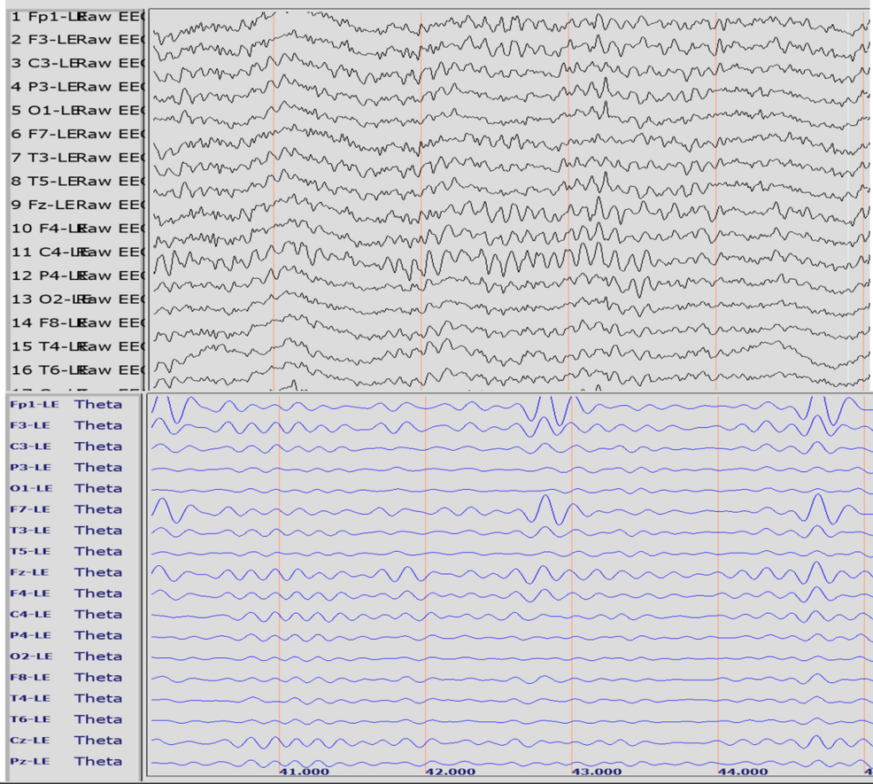Prefrontal, Frontal, and Temporal Theta EEG Asymmetries and