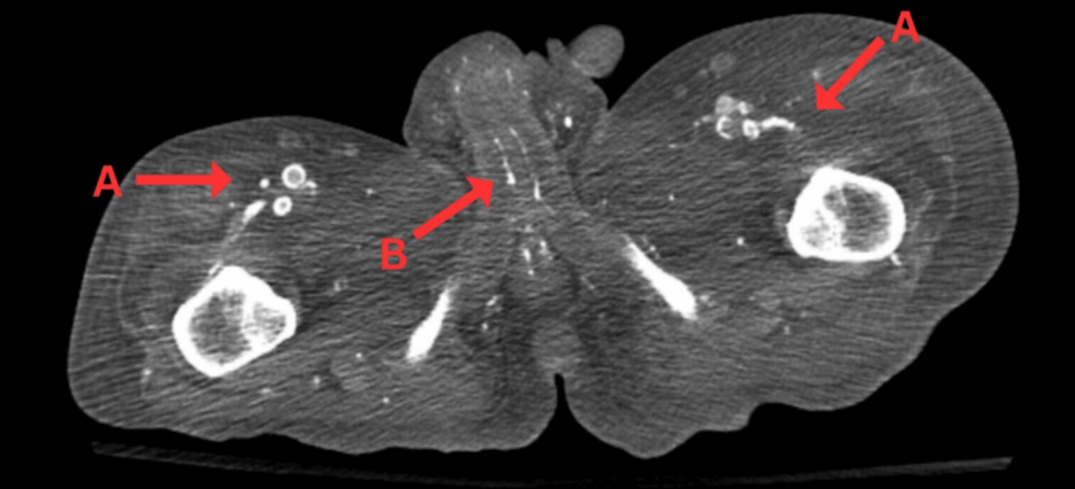 Understanding Calciphylaxis Penile Lesions in End-Stage Renal Disease: A Rare but Serious Complication