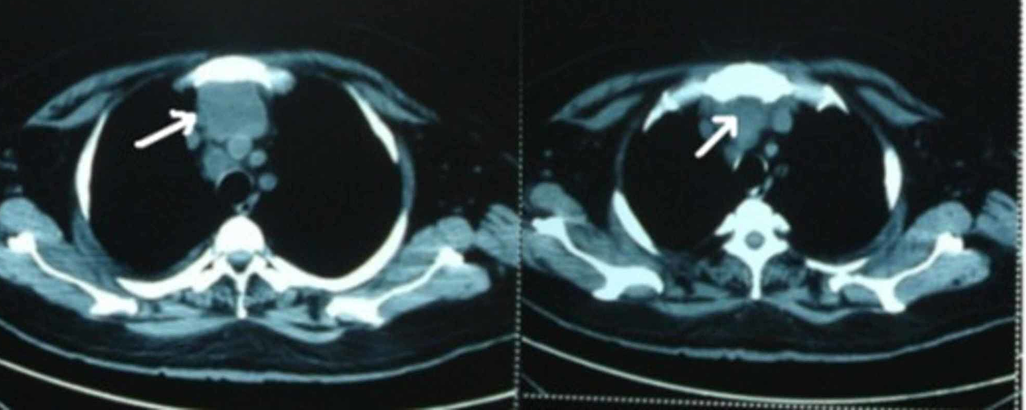 Cureus Cholestasis of Sepsis A Case Report