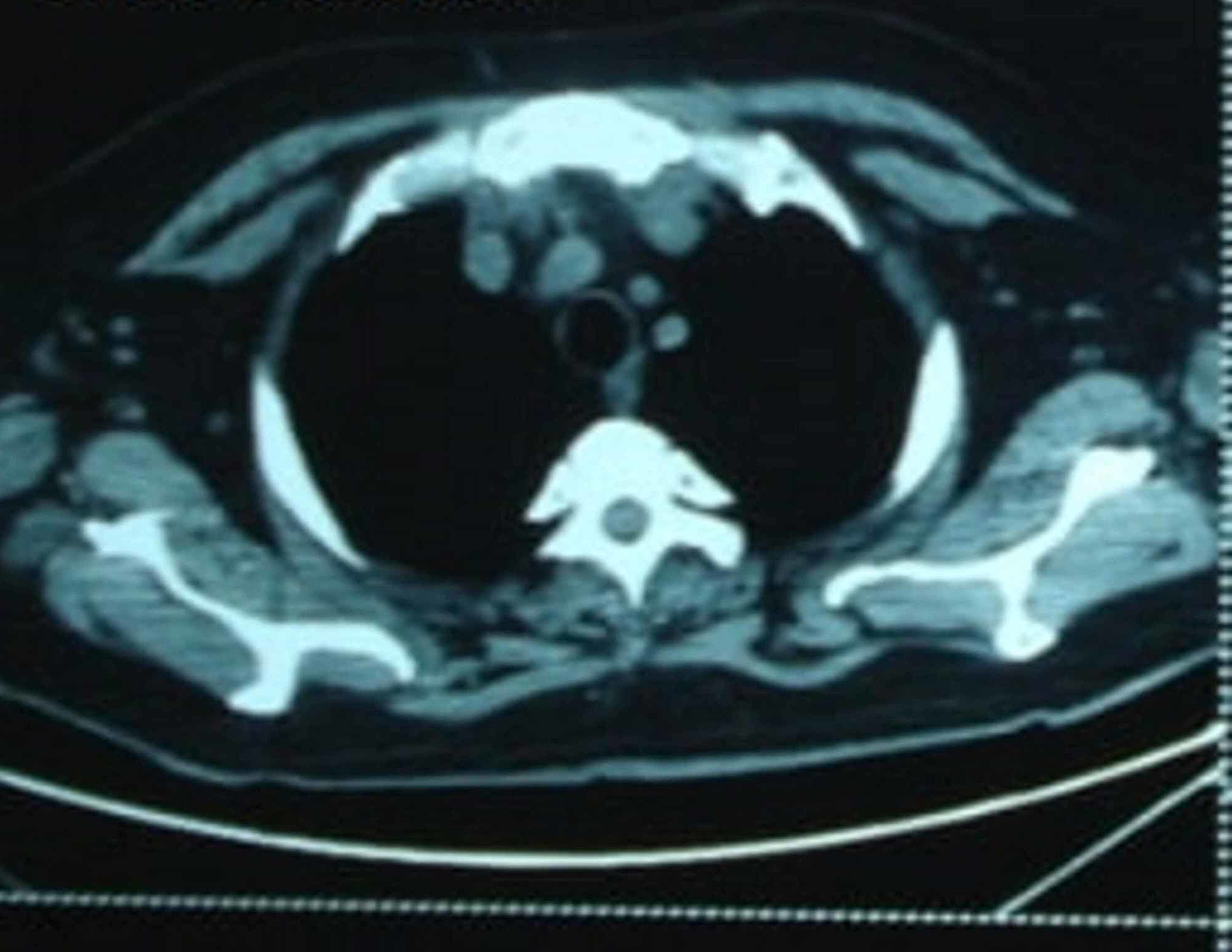 Cureus Cholestasis of Sepsis A Case Report