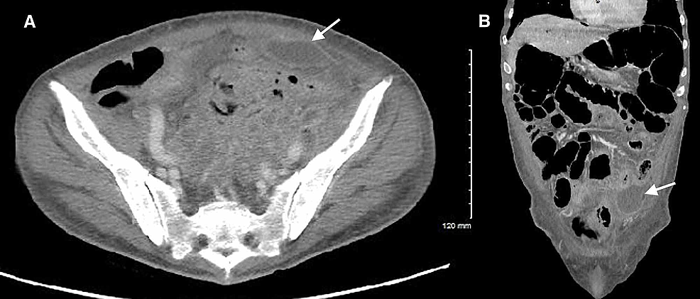 CT-of-the-abdomen/pelvis-demonstrating-an-intra-abdominal-abscess-collection-#2-(white-arrows)-secondary-to-sigmoid-colon-perforation.-Axial-(A)-and-coronal-(B)-planes.