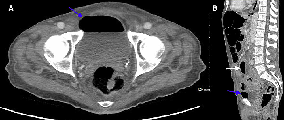 CT-of-the-abdomen/pelvis-demonstrating-air-in-the-urinary-bladder-(blue-arrows)-and-intra-abdominal-abscess-collection-#1-(white-arrow).-Axial-(A)-and-sagittal-(B)-planes.