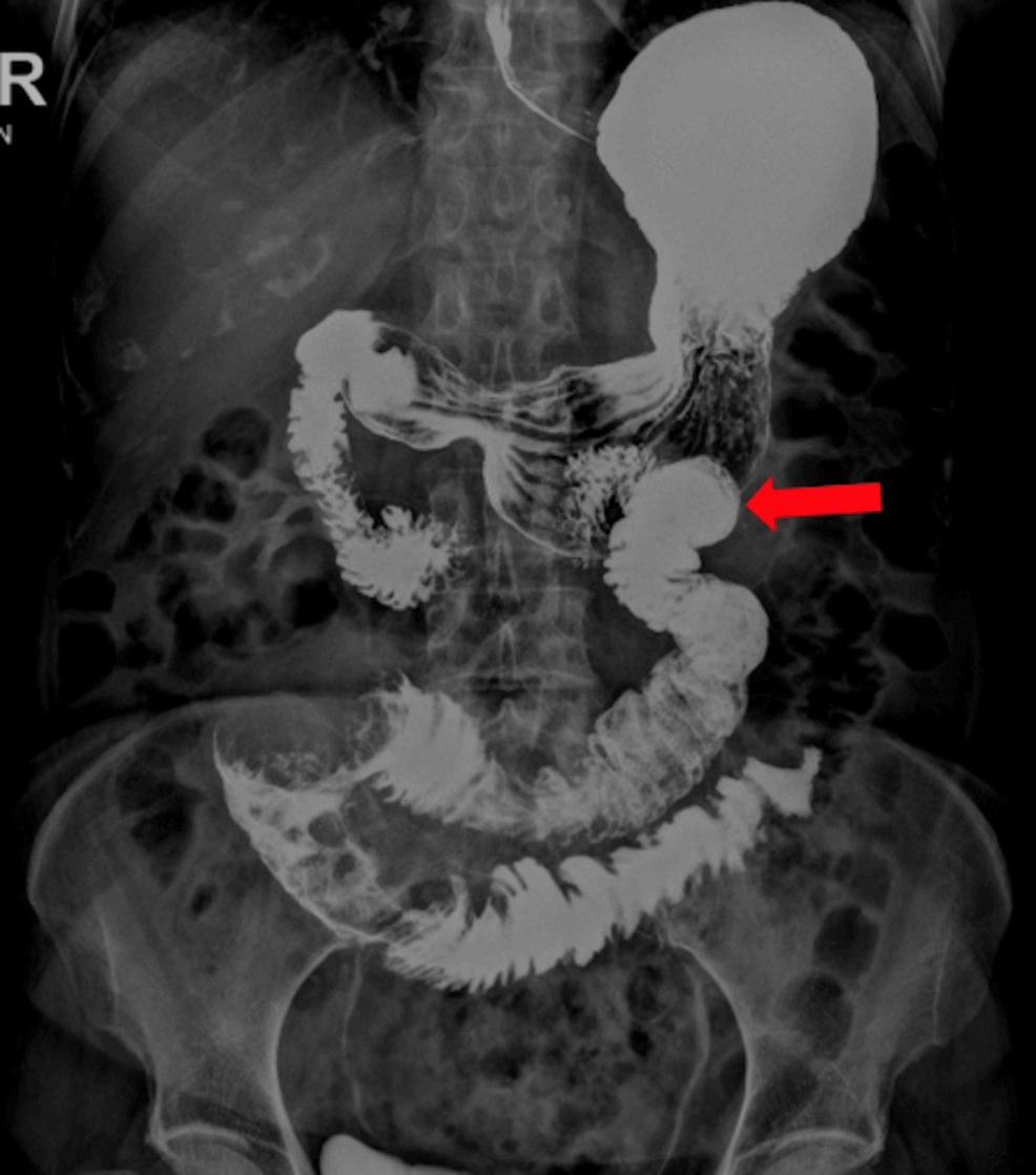 Dysphagia in an 80-Year-Old Woman: A Rare Case of Metastatic