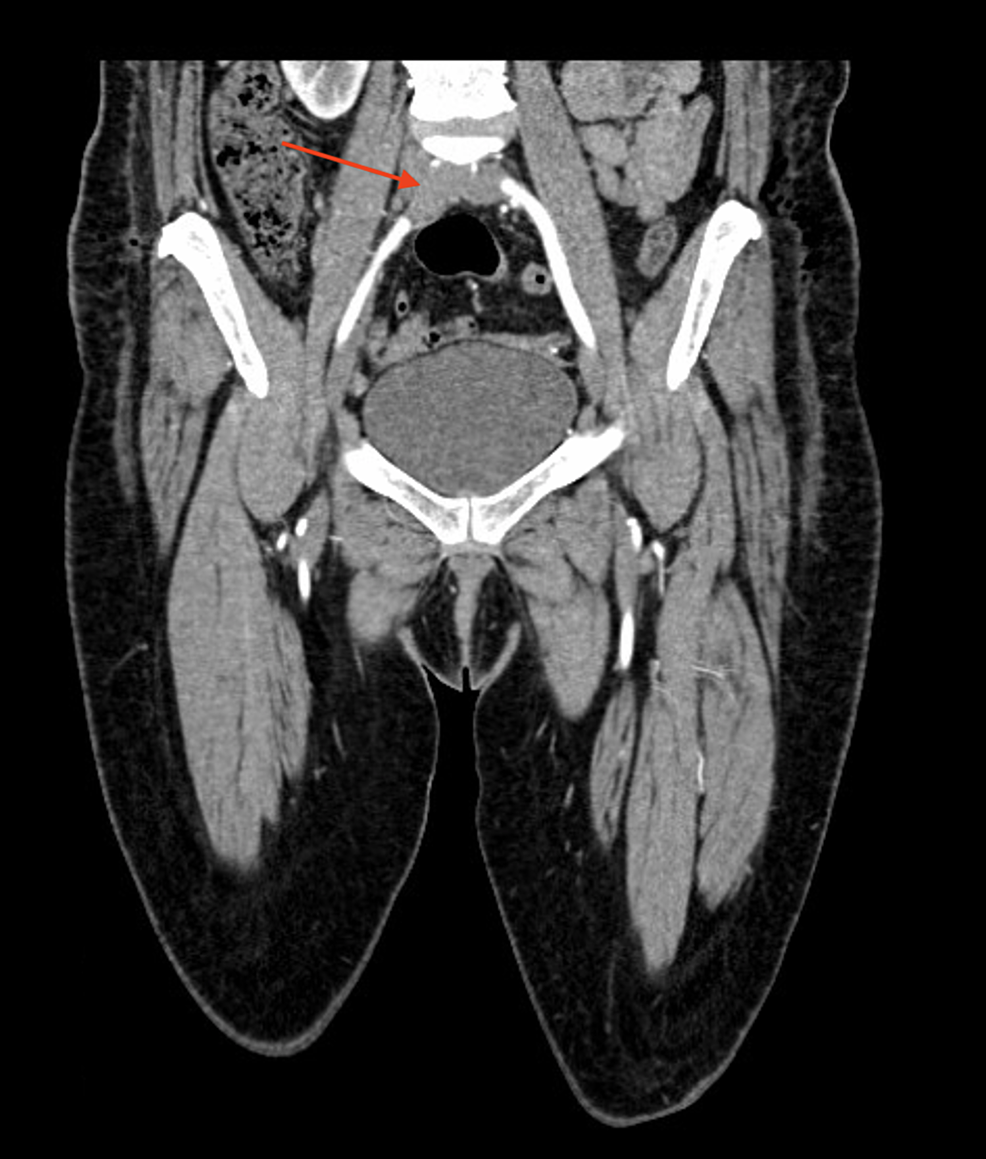 Computed-tomography-angiogram-showing-a-right-common-iliac-occlusion-(arrow)