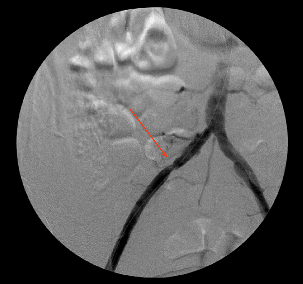 Angiogram-showing-right-common-iliac-artery-stenosis-(arrow)