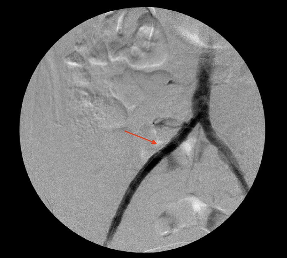 An-angiogram-showing-right-common-iliac-artery-after-thromboembolectomy-and-stent-(arrow)