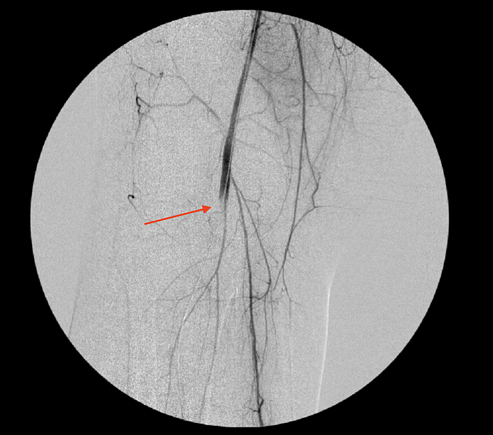 An-angiogram-showing-right-popliteal-artery-occlusion-(arrow)