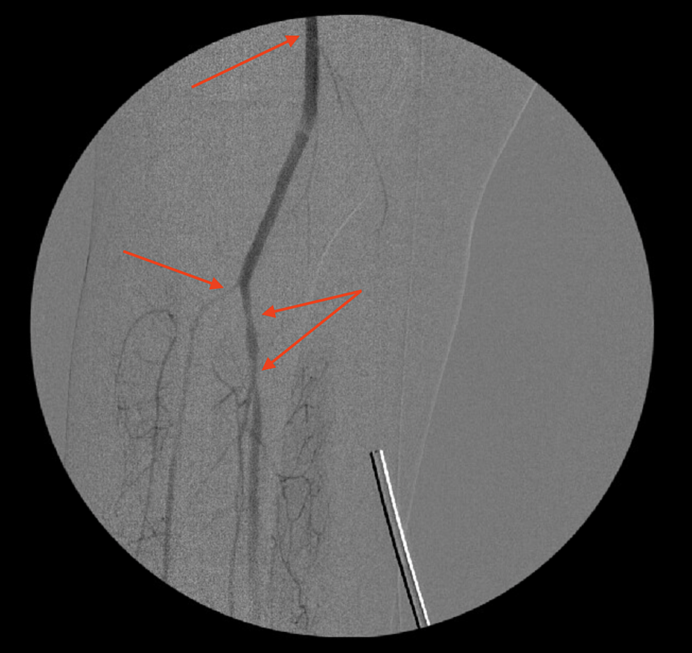 An-angiogram-showing-right-popliteal-artery-after-thromboembolectomy,-and-right-tibioperoneal-trunk-stenosis-(arrows)