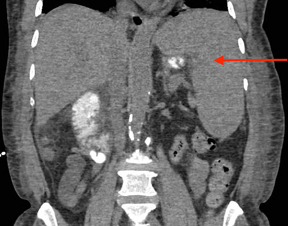 Coronal-section-of-CT-abdomen-revealing-splenomegaly-of-17-cm-(red-arrow).