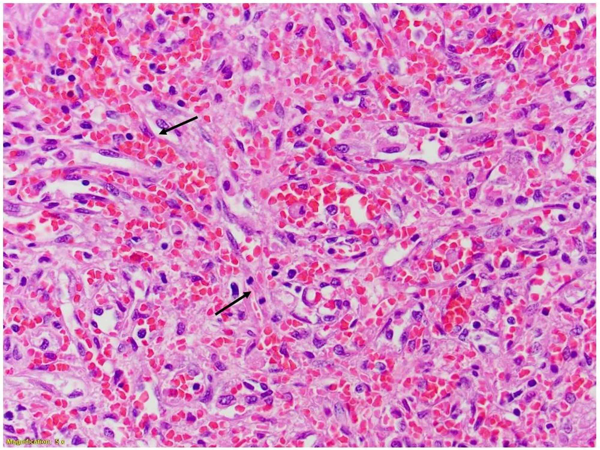 Cureus | A Case Report of Splenic Rupture Secondary to Underlying ...