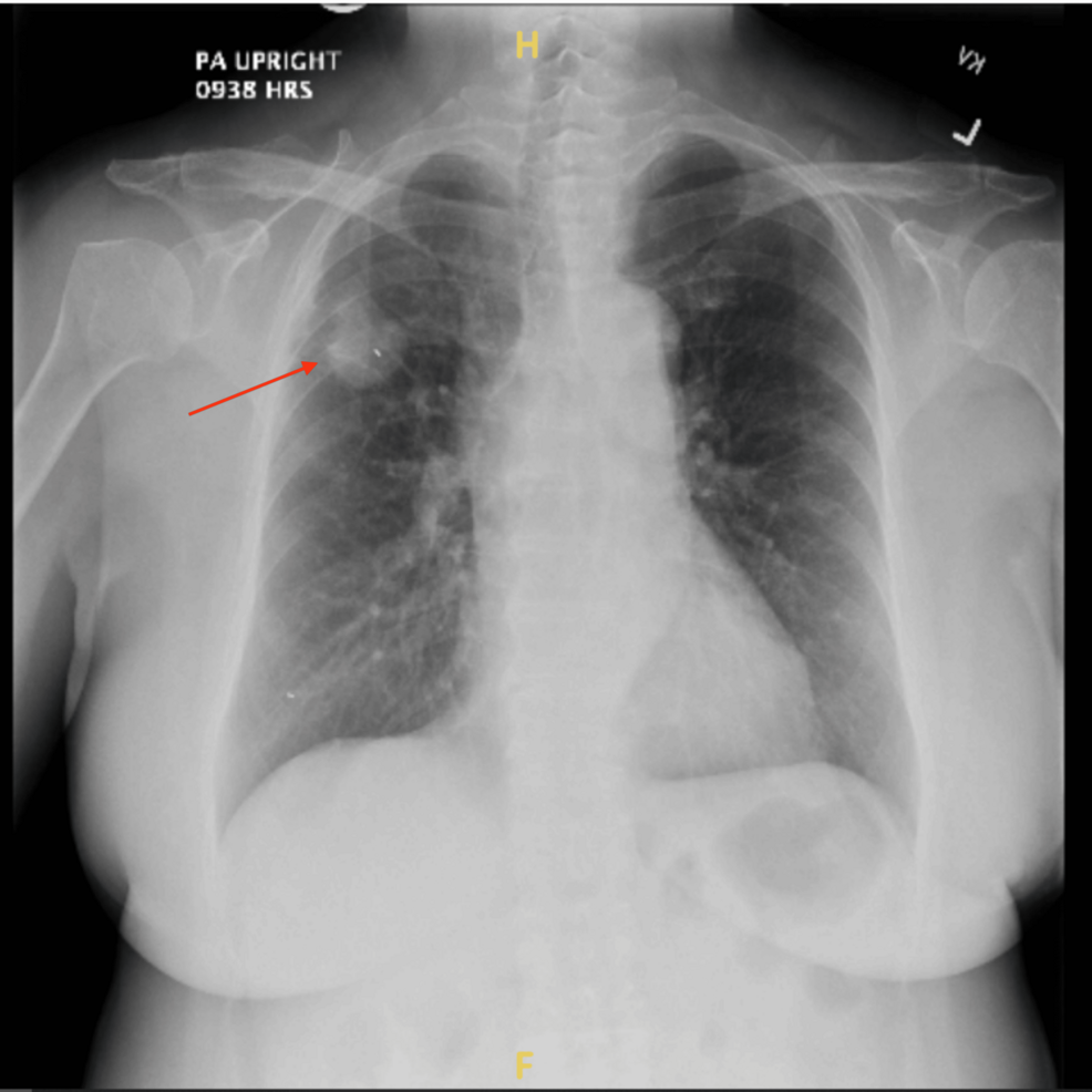 Right-upper-lobe-mass-identified-on-chest-X-ray