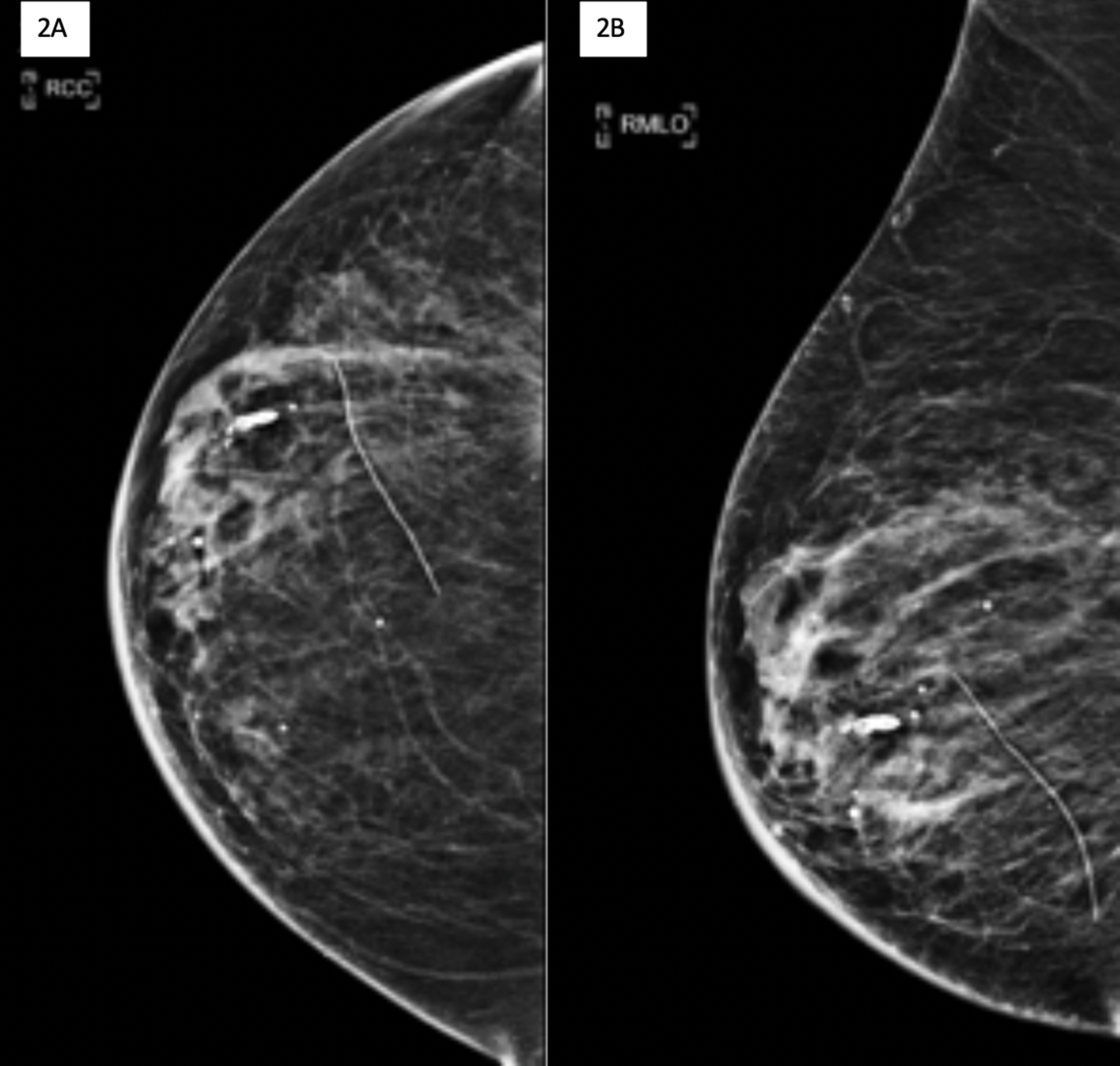 Cureus Hematoma Mimicking Breast Cancer On Ct Scan And Breast Ultrasound