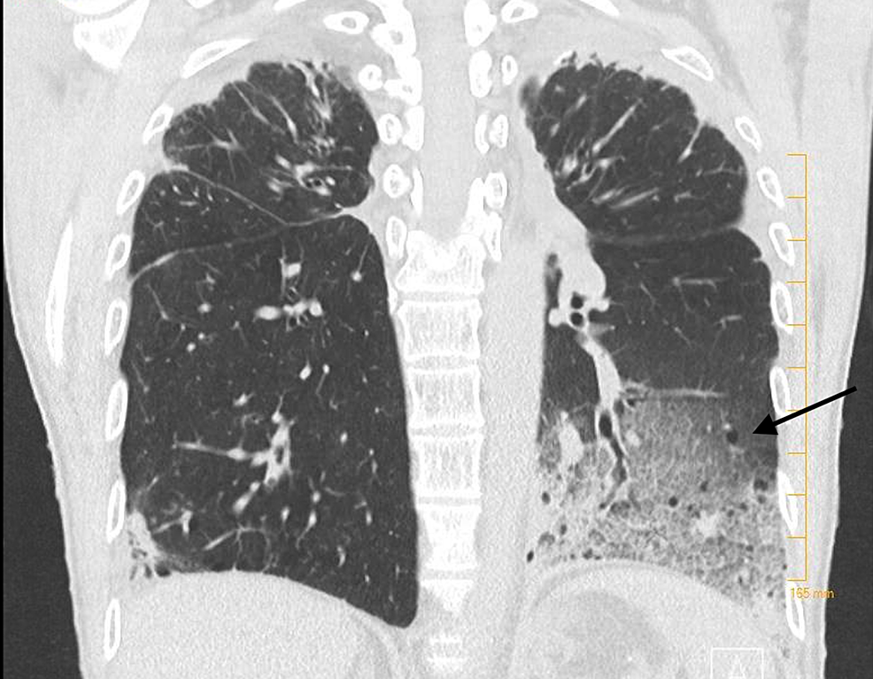 Cureus NeurofibromatosisAssociated Diffuse Lung Disease A Case