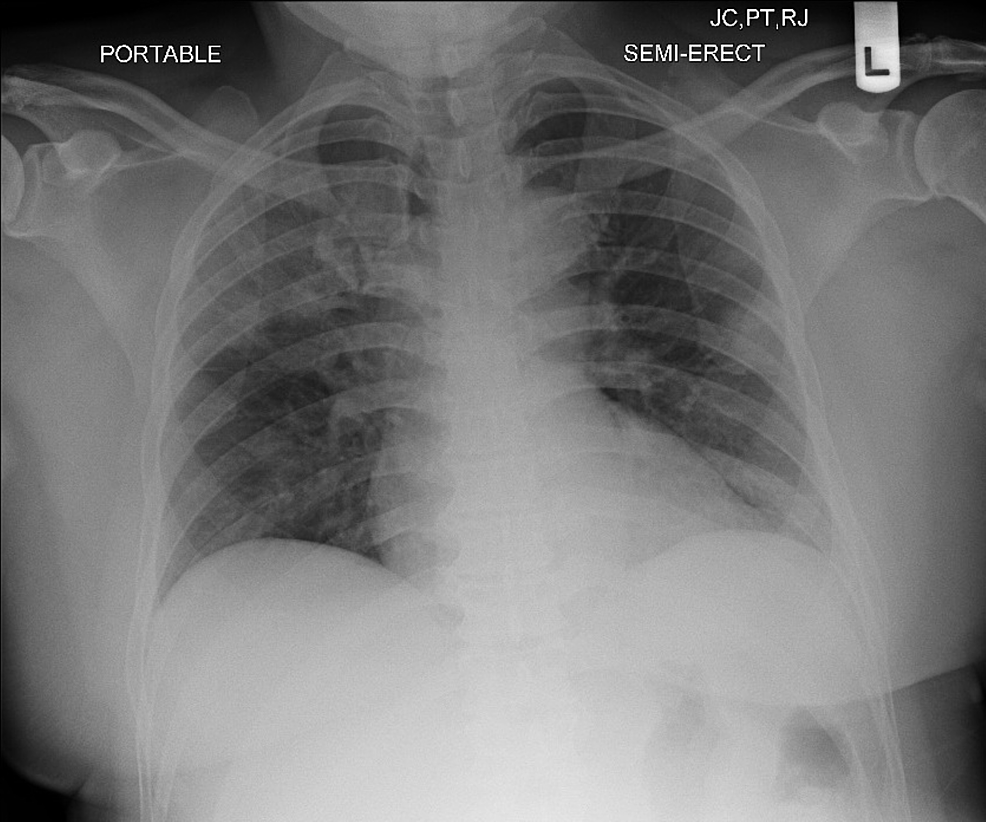 Файл cxr corona как открыть