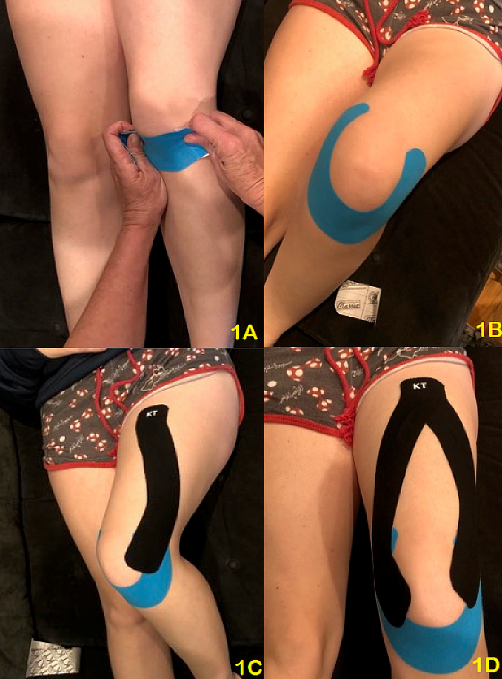 How to apply Kinesiology tape for knee pain - Patella Femoral Syndrome /  Osgood Schlatters Syndrome 