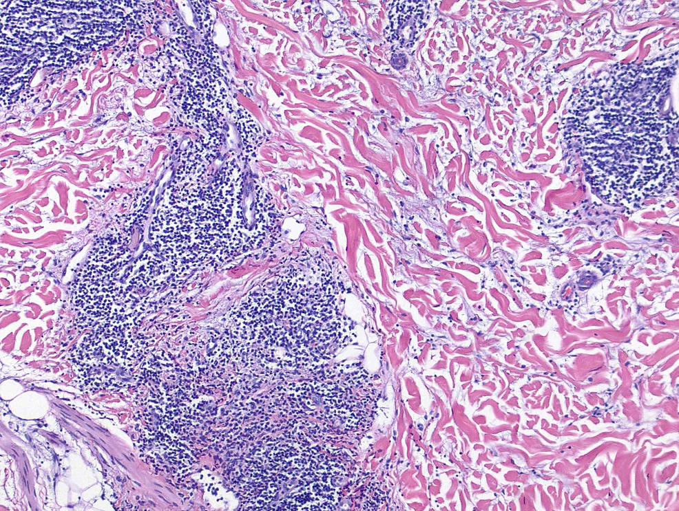 Hematoxylin-and-eosin-stain-of-4-mm-punch-biopsy-(10x-magnification)-of-lesion-demonstrating-deep-perivascular-and-periadnexal-lymphocytic-infiltrate-with-dermal-mucin-deposition-and-edema.
