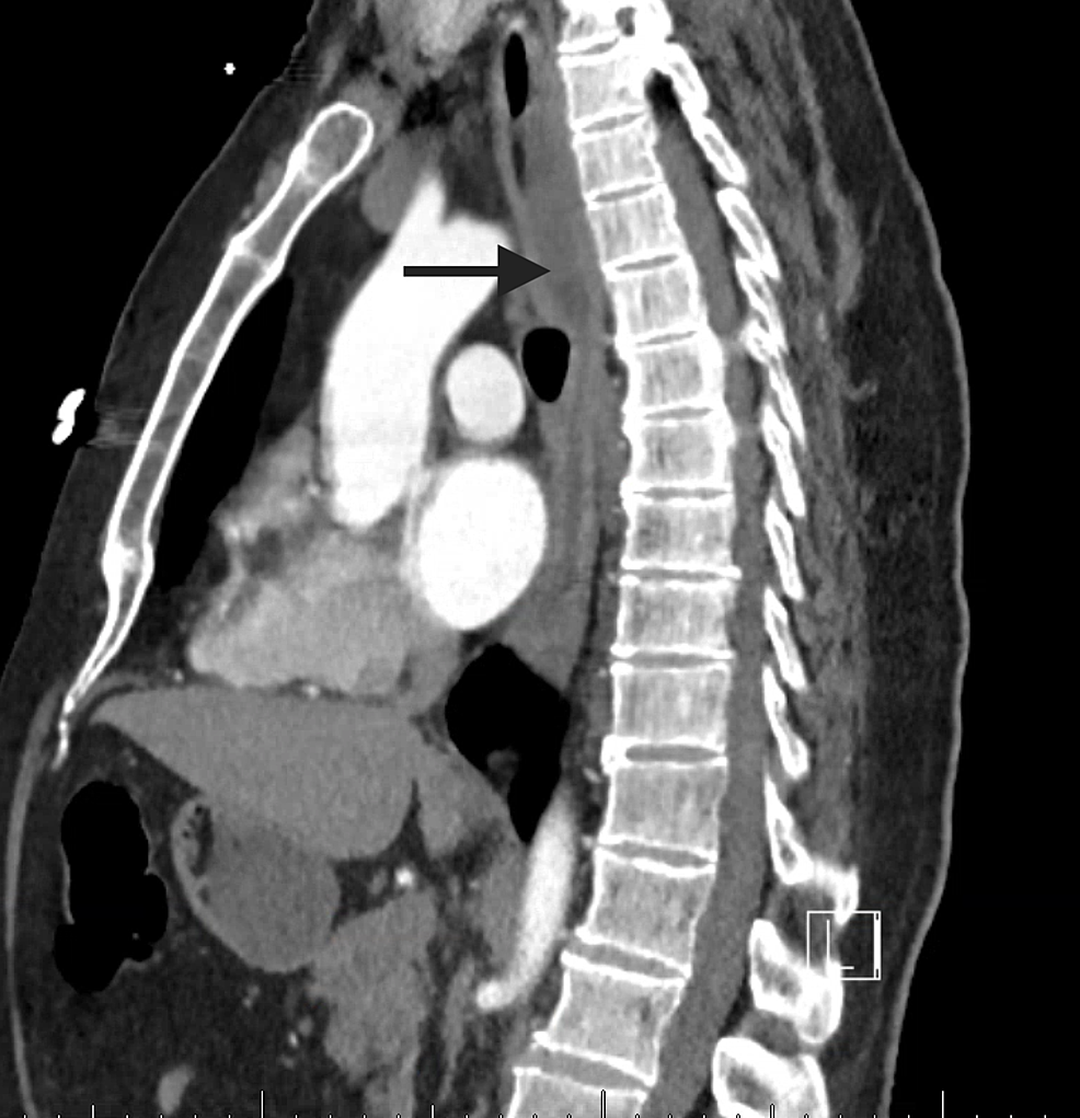 Cureus Esophagitis Dissecans Superficialis Malign Appearance of a