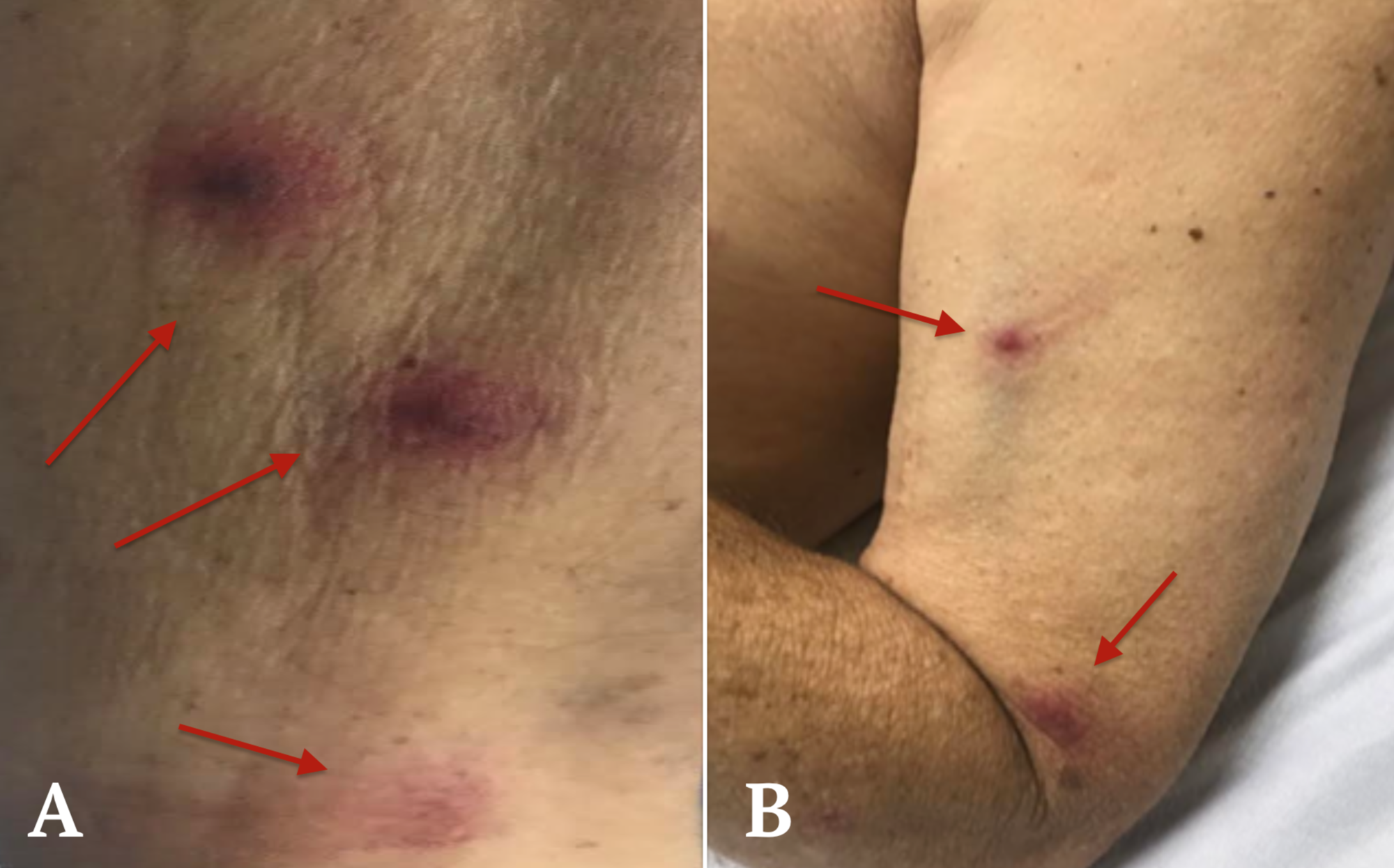Corynebacterium Diphtheriae Wikipedia