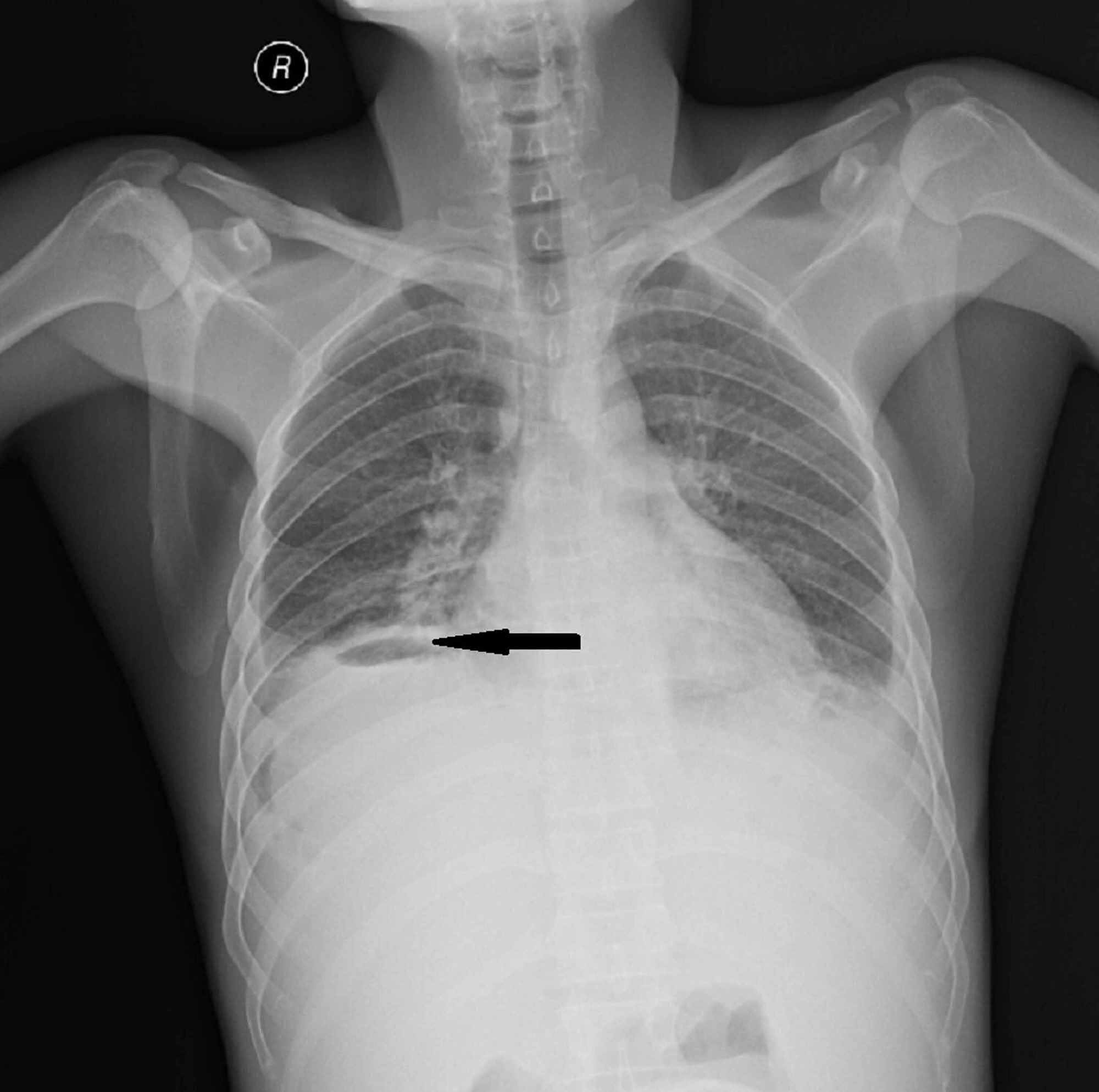 Cureus | Coinfection Of Typhoid Fever With Tuberculosis: A Challenge To ...