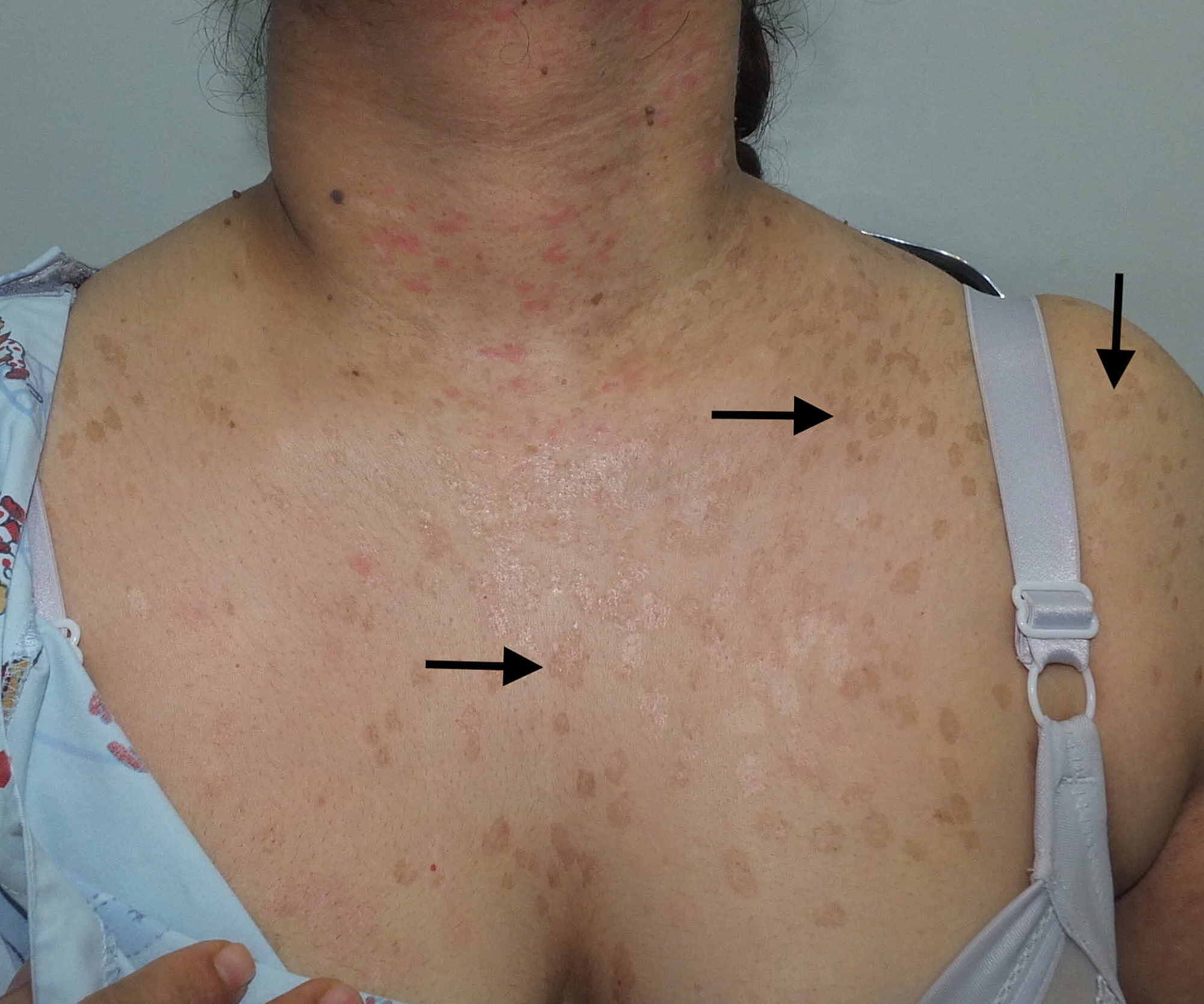 Cureus Epidermodysplasia Verruciformis A Rare Case Report