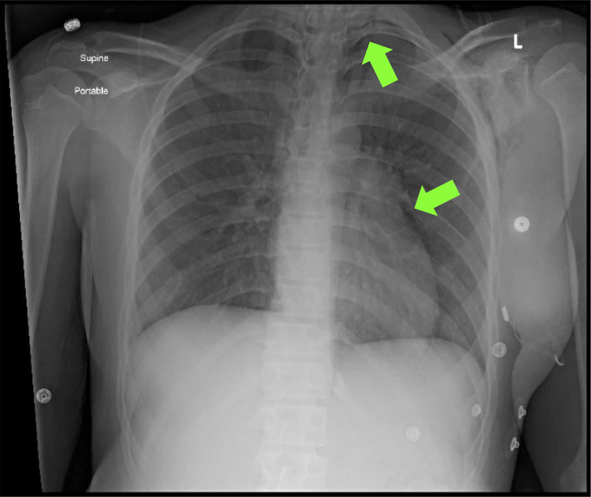 Cureus | Severe Hypercalcemia in an Adolescent with New-Onset Diabetes ...