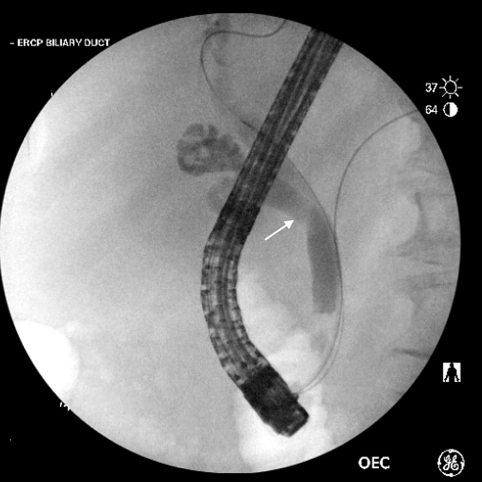 ERCP-revealing-a-filling-defect-(white-arrow)-consistent-with-a-stone-seen-on-cholangiogram.