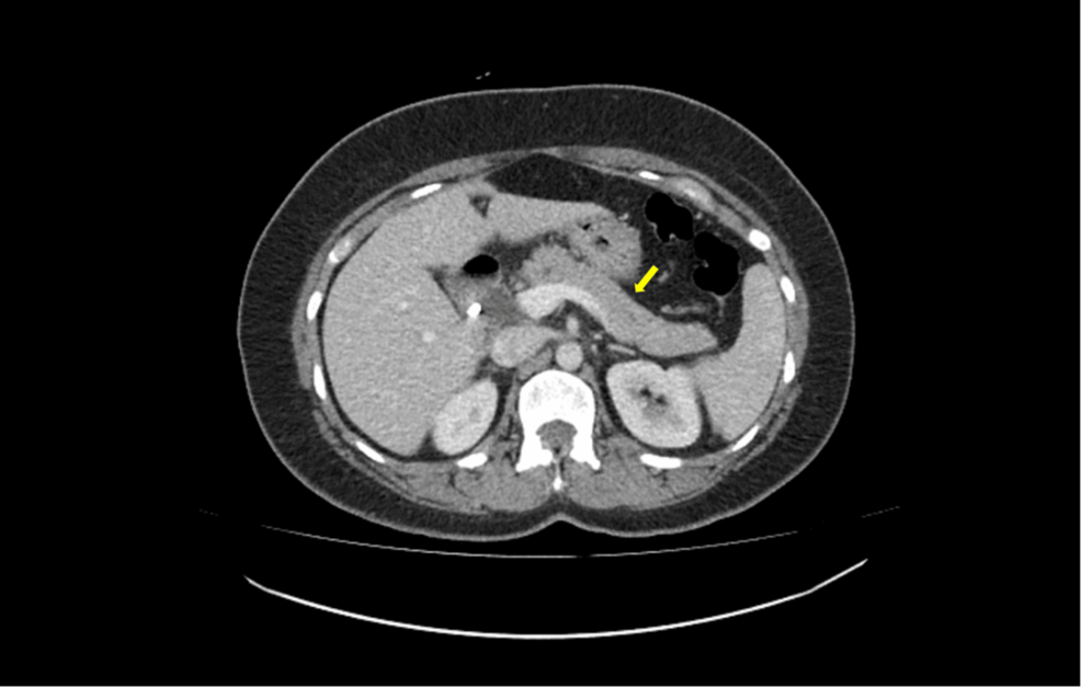 pancreatitis from semaglutide Acute Pancreatitis Likely Due to Semaglutide