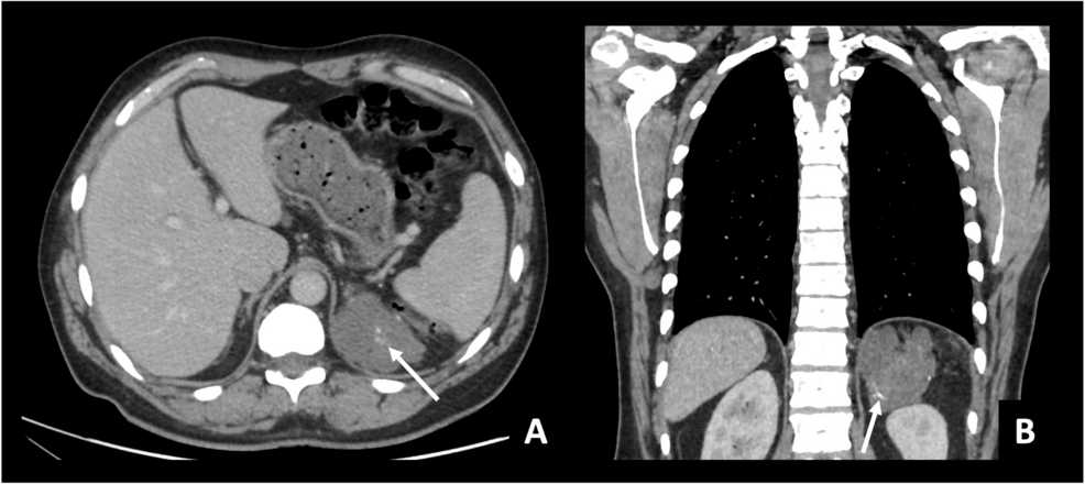 اعوجاج العمود الفقري وورم الغانغليونوما عند الأطفال