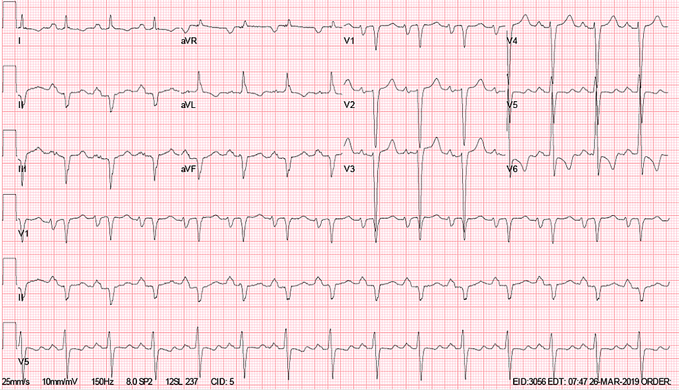 Disappearing “Myxoma”: Left Atrial Thrombus Masquerading as a Myxoma ...