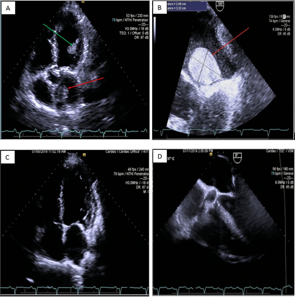 Cureus | Disappearing “Myxoma”: Left Atrial Thrombus Masquerading as a Myxoma