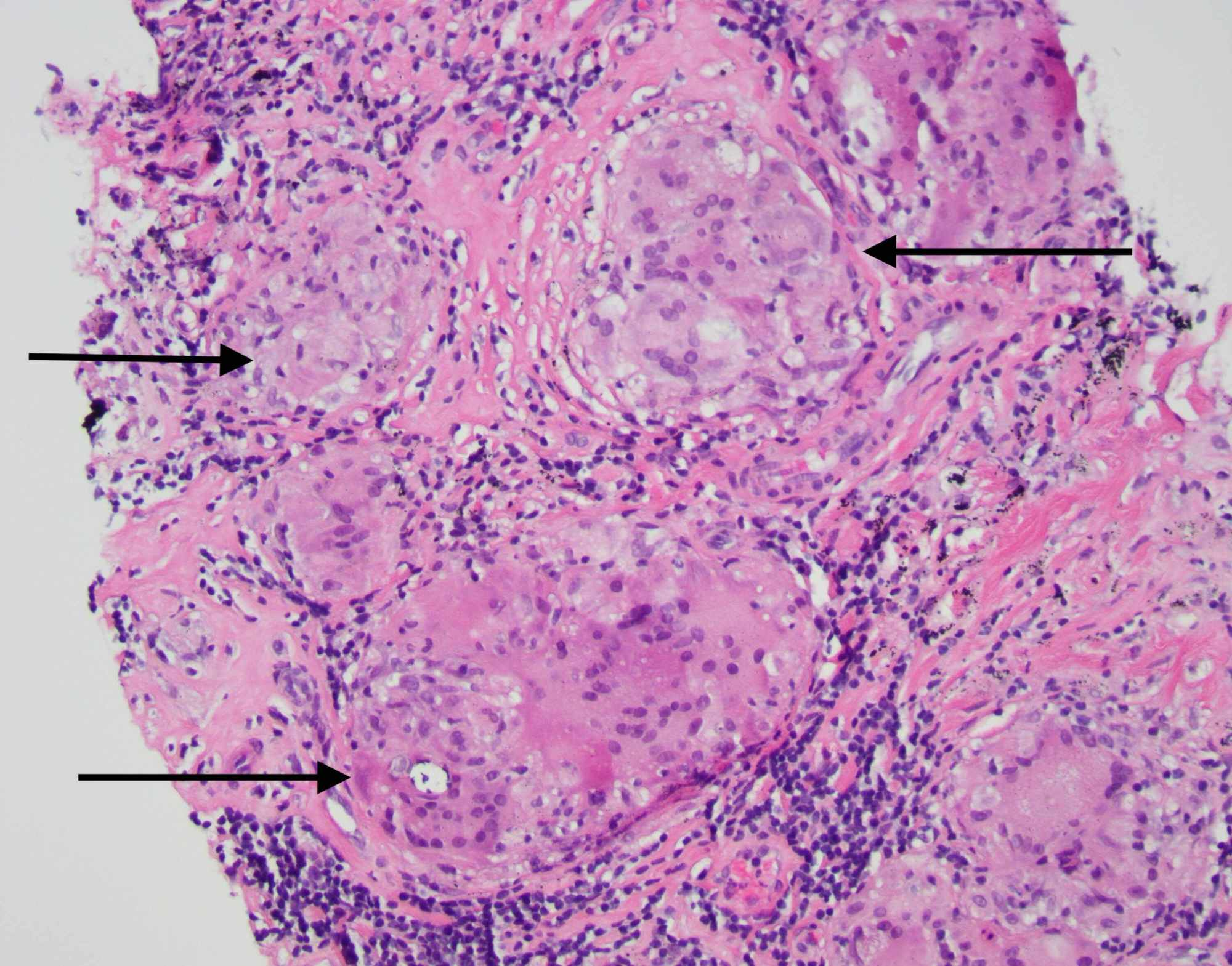 pathological lymph node