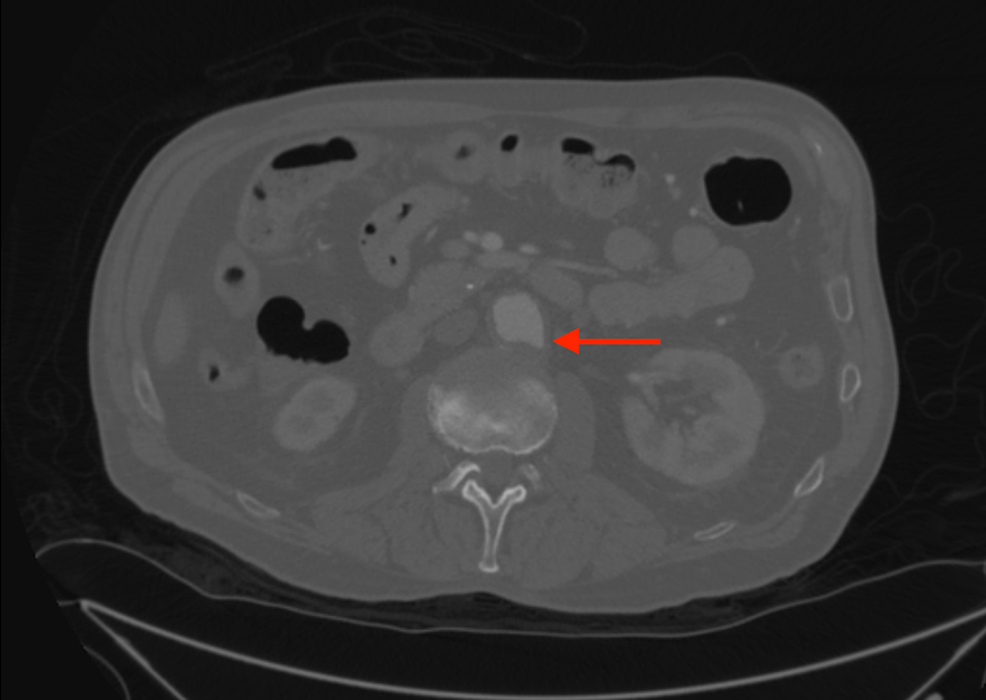 CT-reveals-a-5-mm-penetrating-aortic-ulcer-and-3.6-mm-aneurysm-of-the-infrarenal-abdominal-aorta-(arrow).