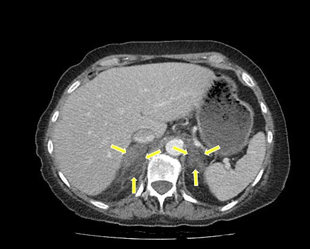 Cureus | Adrenal Insufficiency Secondary to Bilateral Adrenal ...