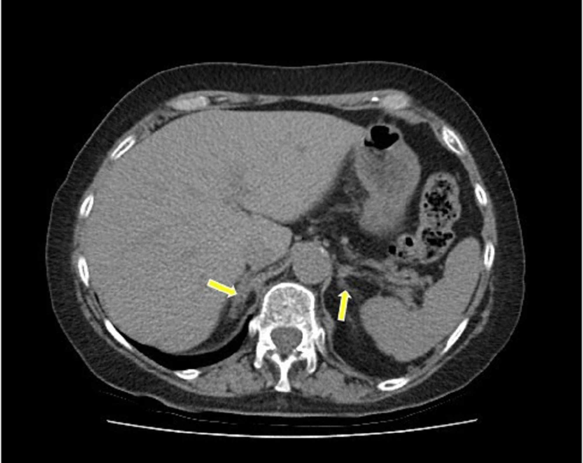Cureus Adrenal Insufficiency Secondary to Bilateral Adrenal